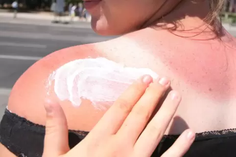 Jeder Sonnenbrand erhöht das Risiko für Hautkrebs, warnen Experten. 