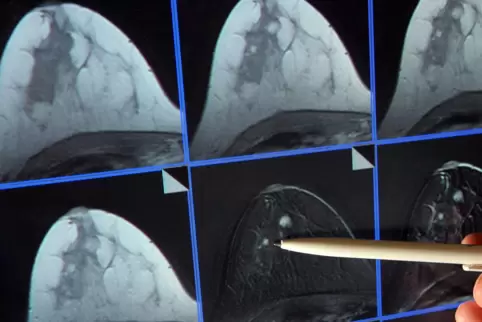 Suche nach Tumoren: Bildschirmdarstellung einer Magnetresonanz-Mammographie. 