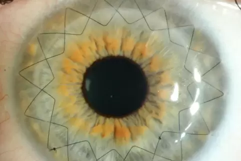 Genähtes Auge nach Hornhaut-Transplantation Genähtes Auge nach Hornhaut-Transplantation