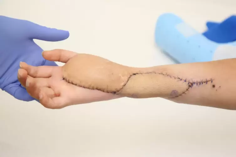 Vor der Operation hing die Hand nur schlaff herunter. So sah sie nach dem gegl&uuml;ckten, elfst&uuml;ndigen Eingriff an der BG Klinik in 