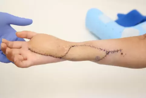 Vor der Operation hing die Hand nur schlaff herunter. So sah sie nach dem geglückten, elfstündigen Eingriff an der BG Klinik in 