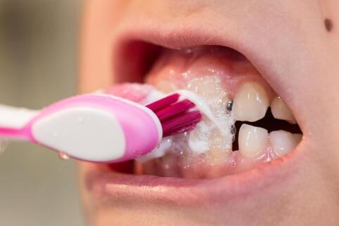 Auch wer regelmäßig Zähne putzt, kann unter Kreidezähnen leiden.