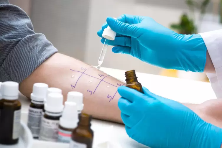 Wer mit Allergien kämpft – im Bild ein „Prick-Test“ der Haut – bekommt oft Cortison.