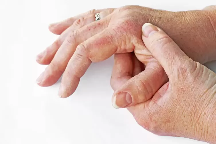 Tritt meist als Folge einer Schuppenflechte auf: die Psoriasis-Arthritis, bei der sich in der Regel mehrere Gelenke entzünden.