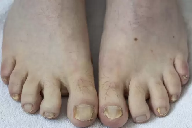 Wer an Nagelpilz erkrankt, benötigt viel Geduld. Die Behandlung ist langwierig und oft kehrt der Pilz zurück. Die Rückfallquote Wer an Nagelpilz erkrankt, benötigt viel Geduld. Die Behandlung ist langwierig und oft kehrt der Pilz zurück. Die Rückfallquote