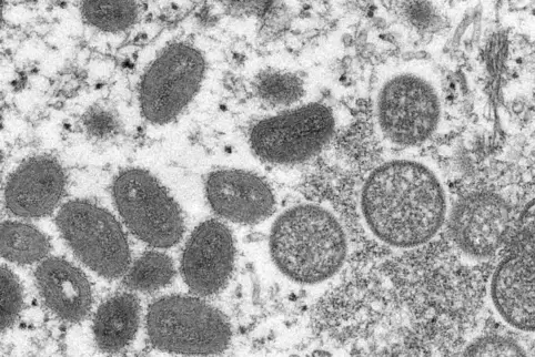 Affenpocken-Viren vergrößert mit einem Mikroskop.