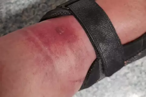 Entzündeter, angeschwollener Fuß nach Kriebelmücken-Biss . 