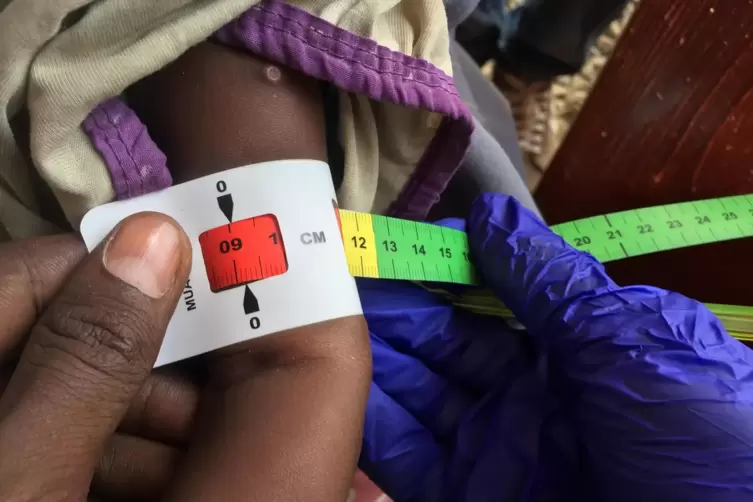 Ein Arzt misst den Armumfang eines somalischen Babys in einer Klinik in Baidoa. Die rote Markierung bedeutet: Das Kind ist schwe