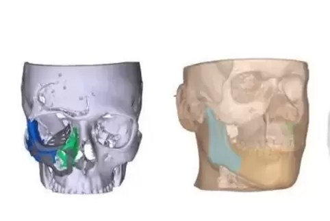 Illustration zu einem individuellen 3D-Druck für Patienten der Mund-, Kiefer- und Gesichtschirurgie am Heidelberger Uni-Klinikum