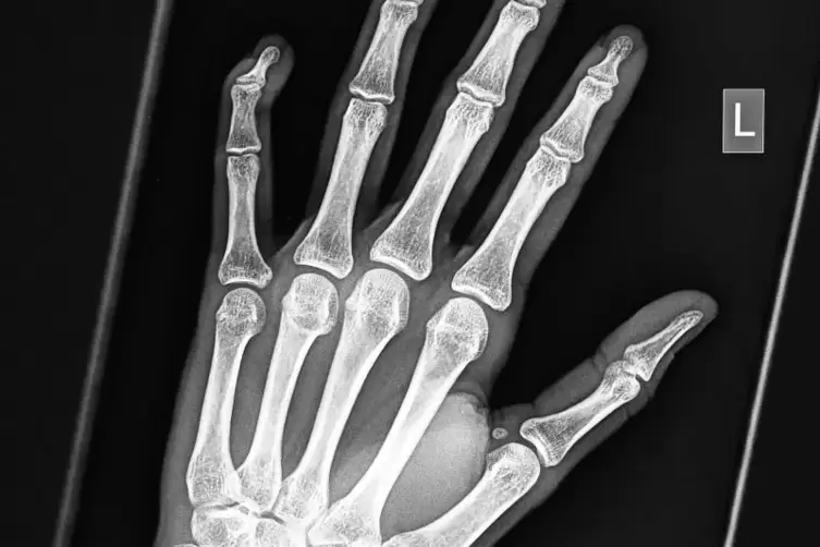 Das Röntgenbild zeigt die Hand einer 16 bis 19 Jahre alten Person.