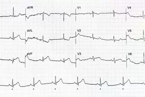 Dieses EKG wurde aus einem Rettungswagen über das Mobilfunknetz an einen Herzspezialisten im Krankenhaus übermittelt. Anhand sei
