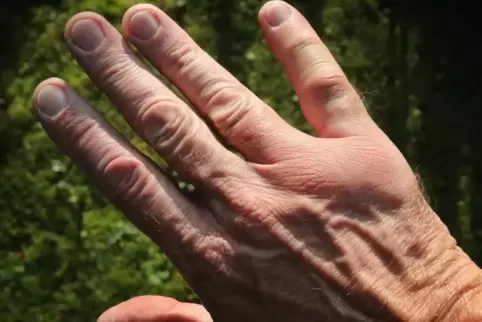 Geschwollene Hand nach Wespenstich. Foto: dpa