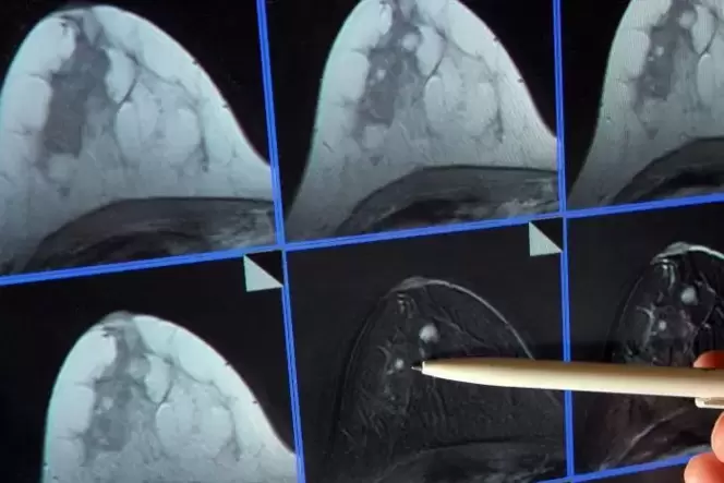 Auf der Bildschirmdarstellung einer Magnetresonanz-(MR)-Mammographie ist ein winziger Tumor in der Brust einer Patientin zu sehe