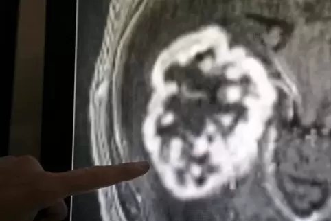 Mit Hilfe der mit Hilfe der Magnetresonanztomographie wurde hier ein Tumor festgestellt.