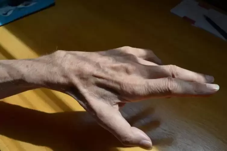 Die Krankheit hat Heinrich Schneiders Hand so verändert, dass er sie kaum bewegen kann. Ringfinger und kleiner Finger sind geläh
