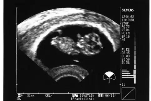 Ultraschallbild: achte Schwangerschaftswoche.